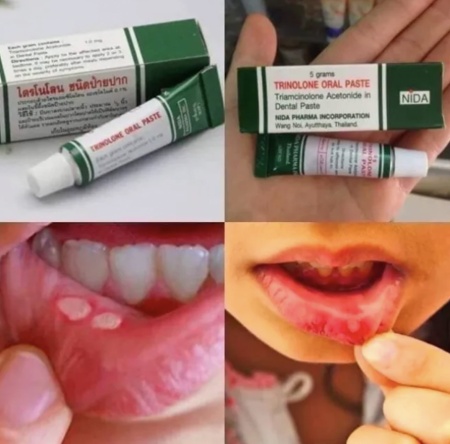 NIDA Тринолоновая паста от стоматита, для лечения и профилактики болезни десен 5гр